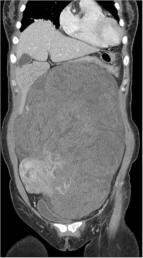 The bowel and the uterus were displaced by the mass.