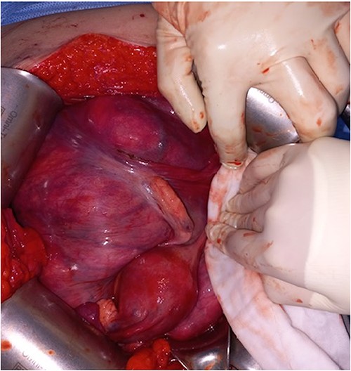 The descending and sigmoid colon, rectum, uterus, and both ovaries were pushed to the right and attached firmly to the rear of the uterus.