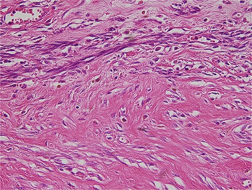 The tumor was composed of spindle cells with moderate to severe, focal nuclear atypia.