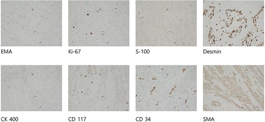 Immunohistological analysis showed negative results for CD34, c-kit, PAN-CK, EMA, and S-100 and positive results for Desmin and SMA. The Ki-67 index was 5%.