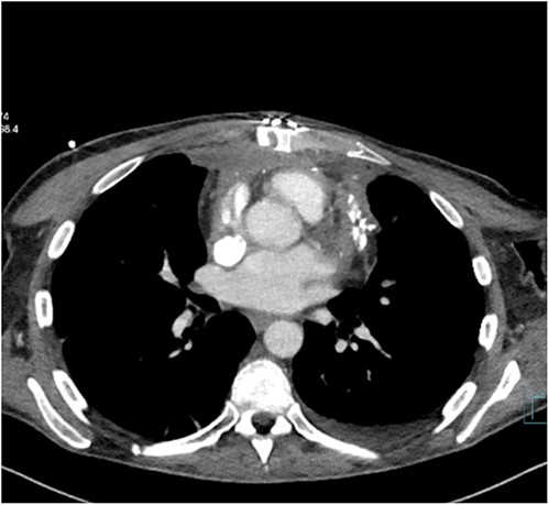 CT demonstrating early stage of constrictive pericarditis.