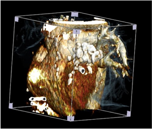 CT revealed organized calcified pericardium.
