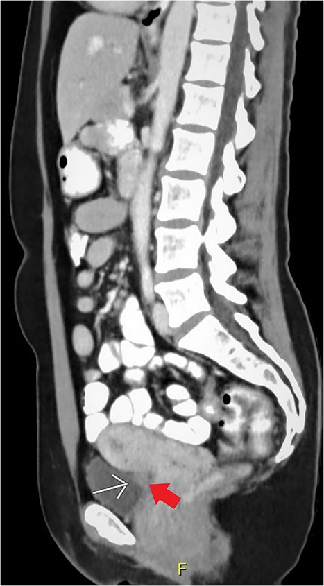 CT scan, sagittal view of the endometriosis nodule in the posterior bladder wall.