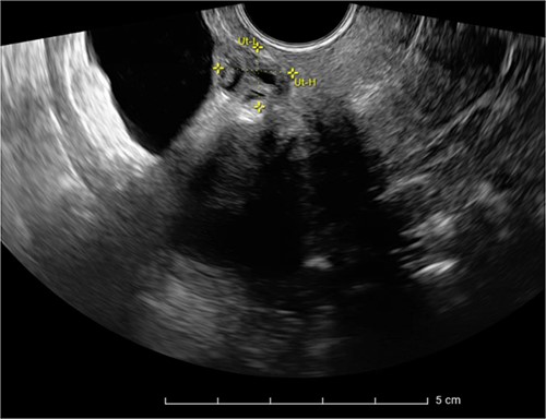 Ultrasound scan showing a heterogeneous endometriosis nodule in the posterior bladder wall not reaching the bladder mucosa.