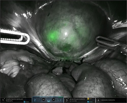 Bladder filled with physiologic water and ICG with subsequent clamping of the urinary catheter.