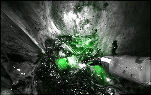 Robotic dissection of the endometriosis nodule between the isthmus of the uterus and bladder; lateral dissection with bilateral transparency of ICG of the thin posterior bladder wall.