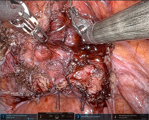 Suturing the posterior bladder wall in a two-layer closure, first the submucosa and muscular layer and second the muscular layer and serosa.