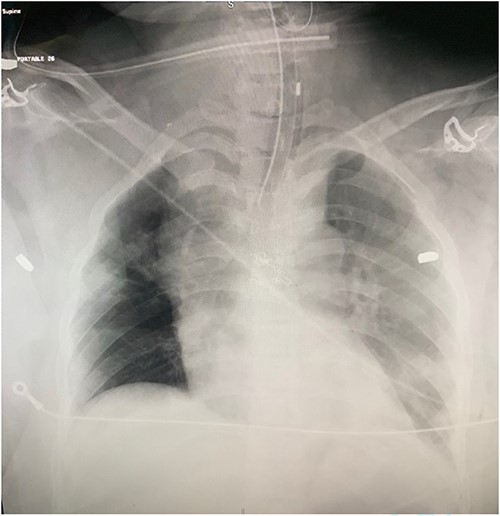 Chest radiograph showing bullet fragments in the chest cavity.