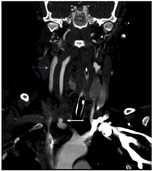 Right common carotid intimal flap (upper arrow) and pseudoaneurysm at origin (lower arrow).