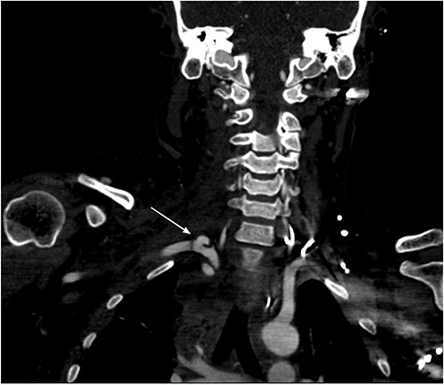 Right subclavian pseudoaneurysm.