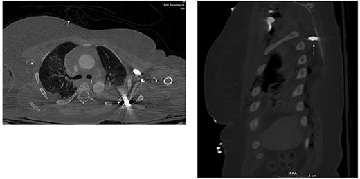 Bullet fragments adjacent to the right acromioclavicular junction and posterolateral.