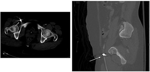 Right distal external iliac artery bullet embolus.