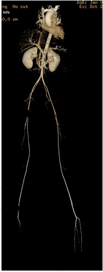 Filling defect in the external iliac artery with no extravasation and the contrast passing to the superficial femoral arteries.