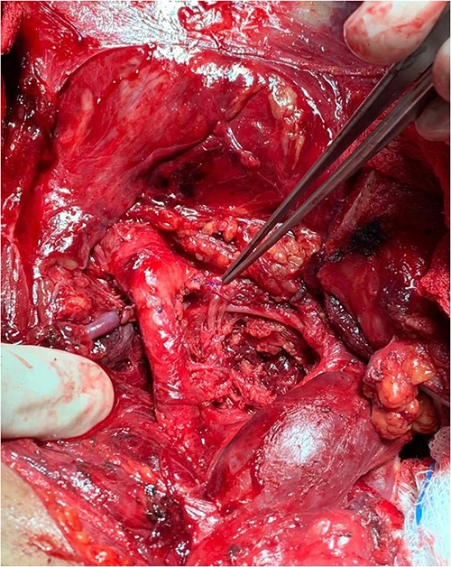 The right common carotid artery end to end anastomosis.