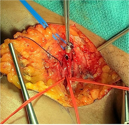 Bullet extraction from right common femoral artery.