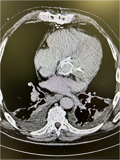 Preoperative computed tomography scans showing calcified aortic valve bioprosthesis in the aortic prosthesis together with pleural effusions.
