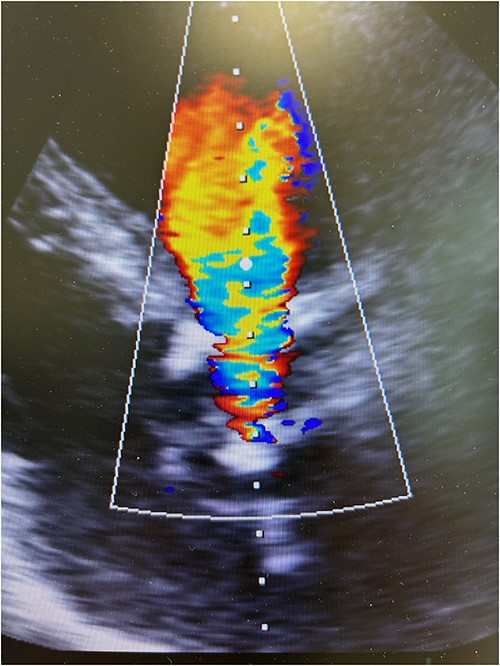 Preoperative transesophageal echocardiography showing significant regurgitation and stenosis of the aortic valve bioprosthesis.