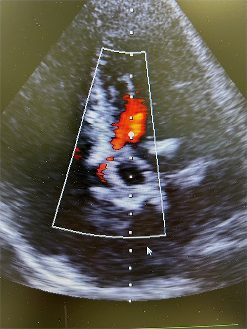 Postoperative transesophageal echocardiography showing nonsignificant regurgitation of a well-seated rapid-deployment Edwards Intuity bioprosthesis.
