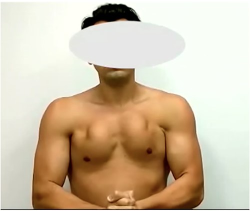 Patient with clinical examination of significant retraction of the PMM with lesion in chronic stage.