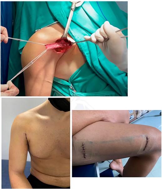Surgical images showing the intraoperative fascia lata graft, cosmetic aspect of the axillary surgical incision and thigh incision for removal of 20 cm of autologous fascia lata graft.