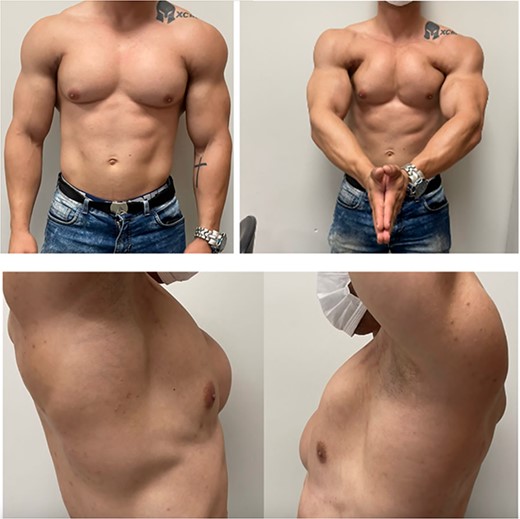 Clinical examination of a patient with simultaneous bilateral pectoralis major rupture in a supine press exercise with a 240 kg load.