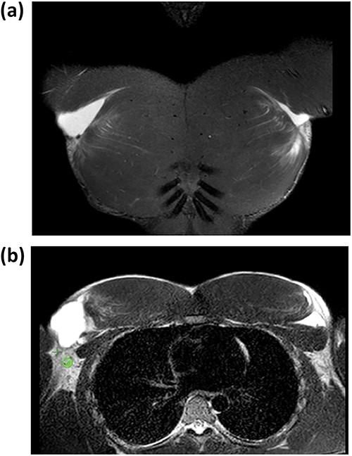 Coronal and axial T2-weighted MRI images showing rupture of the tendon of the bilateral PMM.