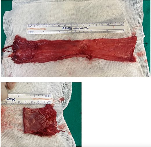 20 cm autologous folded fascia lata graft aimed at PMM tendon reconstruction.