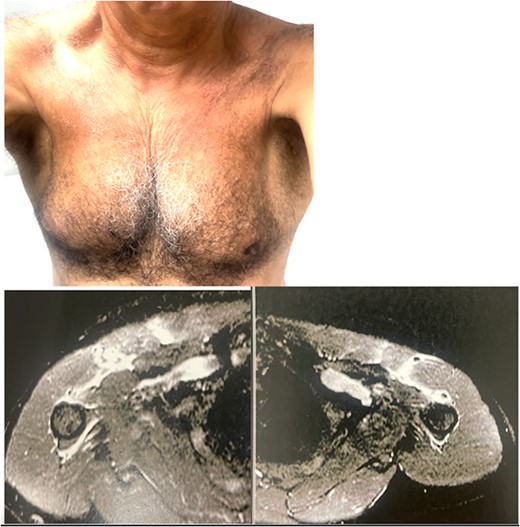 Patient 3 with PMM tendon rupture after sudden force to climb a pit with both hands and exerting great effort to adduct the shoulder.