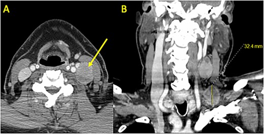Preoperative CT Scan with Contrast. (A) Axial and (B) coronal sections demonstrating bulky left neck lymphadenopathy. Shown are a 3.2 × 2.8 cm level 4 mass in the supraclavicular fossa and a 3.9 × 2.3 cm level 3 mass adjacent to the internal jugular vein and carotid artery. A left thyroid 1.3 cm nodule was identified (not shown) and confirmed as PTC using fine needle aspiration.