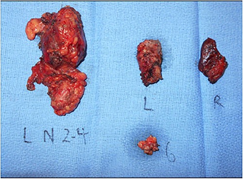 Gross pathology specimen of total thyroidectomy and neck dissection. Total thyroidectomy and left neck dissection specimen revealing a left thyroid 1.6 cm PTC and left neck level 2–4, 6 lymph nodes with final pathology yielding 16/42 positive nodes with extranodal extension and lymphovascular invasion. L, Left thyroid lobe; R, Right thyroid lobe, 6, level 6 lymph node packet; L N 2–4, left level 2–4 lymph node packet.