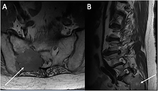Magnetic resonance imaging of the lumbar spine. (A) Axial and (B) sagittal sections demonstrating an expansive 5 × 4 cm lesion in R sacroiliac joint. CT-guided core biopsy of the mass confirmed metastatic PTC.