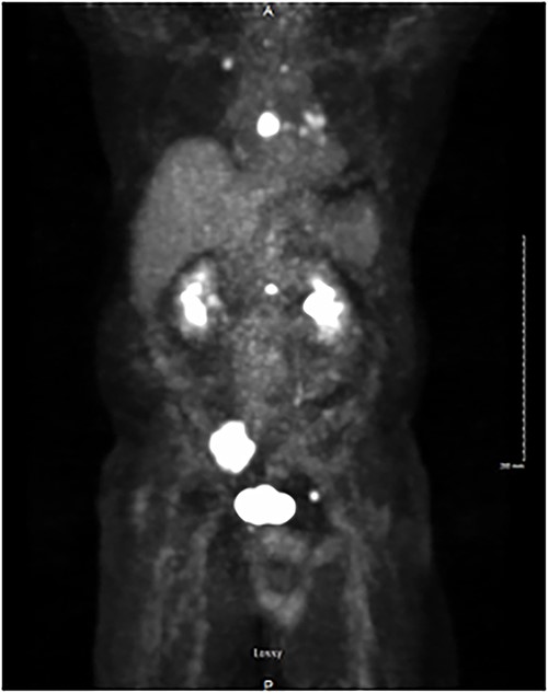 PET/CT demonstrating isotope uptake indicative of metastatic disease. Coronal section demonstrating no evidence of neoplastic disease in the head and neck region. Several foci of metastatic disease are present at the level of thoracic inlet. Shown are a 5 cm lytic metastatic focus involving R sacrum, 1.5 cm isotope positive focus of lytic metastatic disease involving the mid-portion of the sternum, and smaller positive foci involving left side of body of L-1, anterior aspect of left acetabulum, posterior aspect of 7th left rib, medial aspect of right clavicle and left transverse process of T-1.