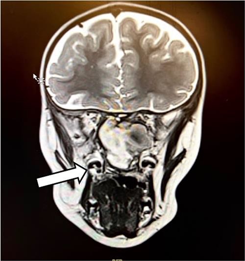 The coronal section of the MRI.