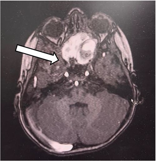 The axial section of the MRI.