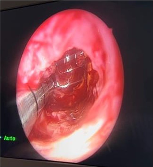 Evacuation of the mass.