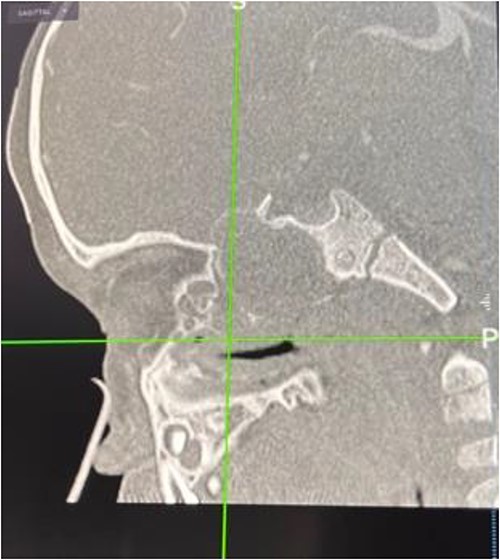 Skull base erosion on CT navigation.