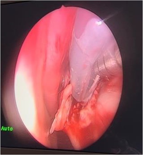 Doyle splint inserted.