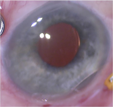 External photograph at the conclusion of initial scleral fixation. The IOL is well-positioned.