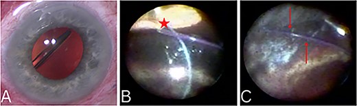 External photograph showing significant lens tilt (A). Ophthalmic endoscopy demonstrating lens tilt with twisting and subsequent damage to the optic-haptic junction (Star in 2B). Endoscopy revealed haptic remained secured in the scleral tunnel (Arrows in 2C).