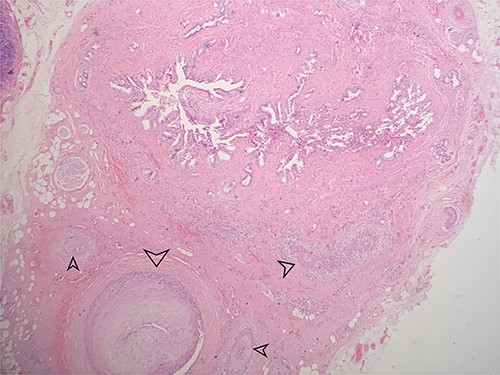 Low power view showing the mucosa of the gallbladder with multiple small and medium sized blood vessels shown by arrows (H&E 40X).