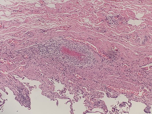 Intraluminal thrombi, fibrinoid necrosis with perivascular infiltration by lymphocytes, neutrophils, and eosinophils (H&E 200X).