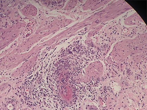 Intraluminal thrombi, fibrinoid necrosis with perivascular infiltration by lymphocytes, neutrophils, and eosinophils (H&E 200X).