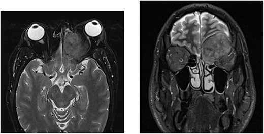 MRI with contrast shows a large left anterior cranial fossa and extra-axial extradural solid mass involving the left olfactory groove with bony erosion. There is a large component on the superior and medial extraconal orbital causing left proptosis. Direct involvement of the left frontal sinus is observed. (a) Axial view. (b) Coronal view.