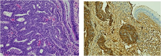 Histological findings. (a) Respiratory epithelium showing infiltration by a tumour comprising cribriform sheets of relatively uniform rounded tumour cells with prominent nucleoli in keeping with adenocarcinoma. Morphological features along with immune profile (keratin positive, negative for CK 7 & 20) pointed to a prostatic primary. (b) Positive immunohistochemistry staining with PSA marker.