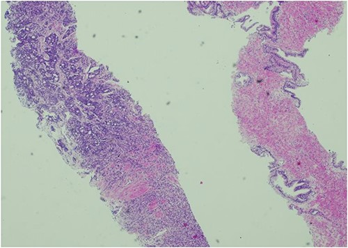 Histology of prostatic tissue showing adenocarcinoma. Gleason score 5 + 4 = 9, Gleason group 5. 5/24 cores were positive for adenocarcinoma.