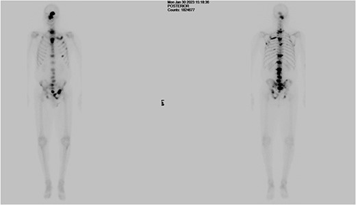 Bone scan showing multiple areas of increased tracer uptake, including the skull vault and skull base, cervical spine, thoracic spine, lumbar spine, and pelvis, revealing multiple bony metastases.
