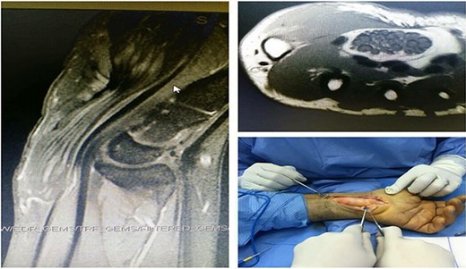 Ultrasound imaging showed a hyperechogenic lesion adjacent to the left wrist; MRI scans showed an abnormally expanded median nerve with a coaxial cable or spaghetti-like appearance.