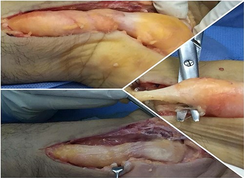The removal of LFH from the patient wrist.