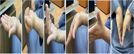 Range of motion in patient wrists and fingers after recovery.