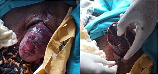 The eviscerated left lobe of the liver through the midline incision.